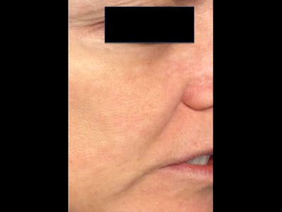 Microneedling Before & After Gallery - Patient 87551861 - Image 2