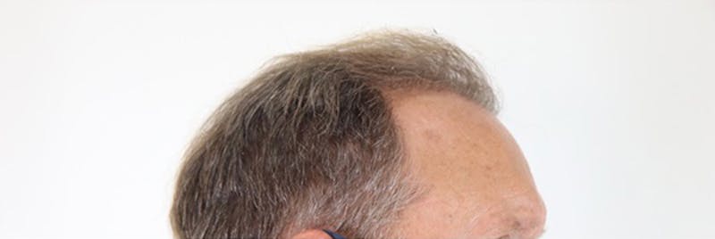Hair Restoration Before & After Gallery - Patient 87551864 - Image 5
