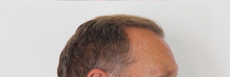 Hair Restoration Before & After Gallery - Patient 87551864 - Image 6