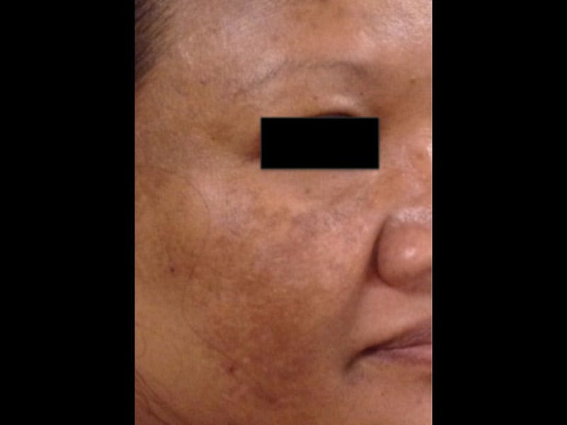 Microneedling Before & After Gallery - Patient 87551878 - Image 1