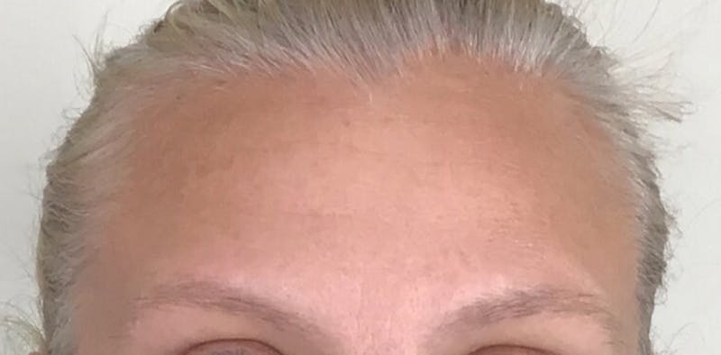 BOTOX Before & After Gallery - Patient 87551866 - Image 4