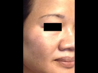 Microneedling Before & After Gallery - Patient 87551878 - Image 2