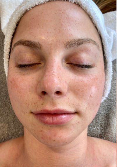 Chemical Peels Before & After Gallery - Patient 87551881 - Image 1