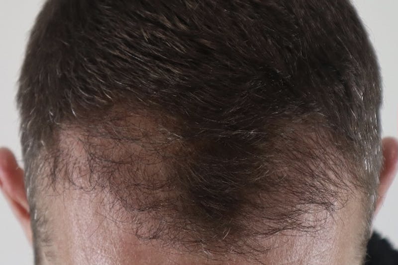 Hair Restoration Before & After Gallery - Patient 87551931 - Image 1