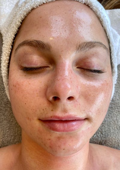 Chemical Peels Before & After Gallery - Patient 87551881 - Image 2
