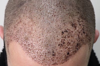 Hair Restoration Before & After Gallery - Patient 87551931 - Image 2