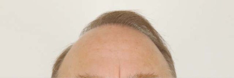 Neograft Before & After Gallery - Patient 87551884 - Image 3