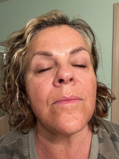 Chemical Peels Before & After Gallery - Patient 87551902 - Image 1