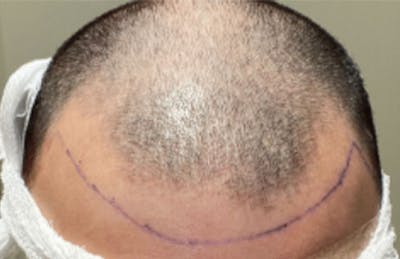 Neograft Before & After Gallery - Patient 87551900 - Image 1
