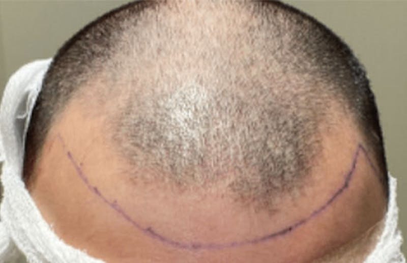 Neograft Before & After Gallery - Patient 87551900 - Image 1