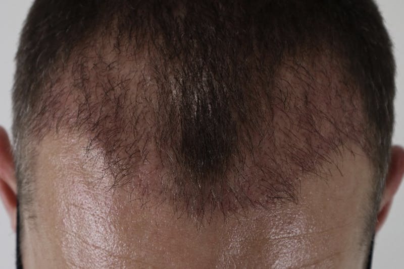 Hair Restoration Before & After Gallery - Patient 87551931 - Image 4
