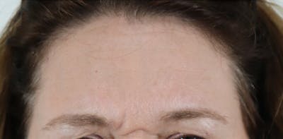 BOTOX Before & After Gallery - Patient 87551907 - Image 1
