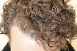 Hair Restoration Before & After Gallery - Patient 87551931 - Image 6