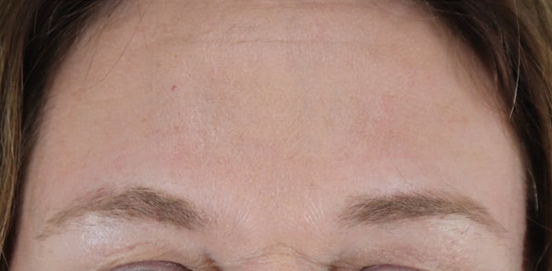 BOTOX Before & After Gallery - Patient 87551907 - Image 2