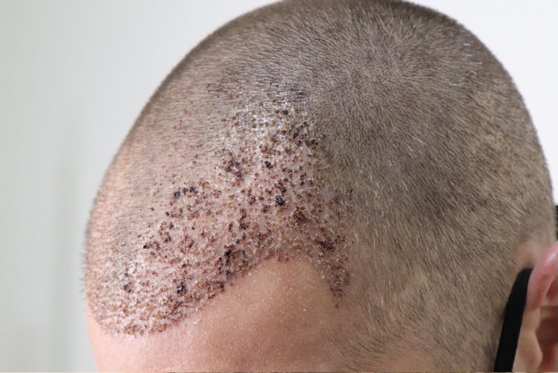Hair Restoration Before & After Gallery - Patient 87551931 - Image 7