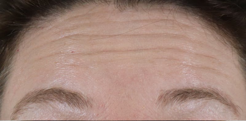 BOTOX Before & After Gallery - Patient 87551907 - Image 3