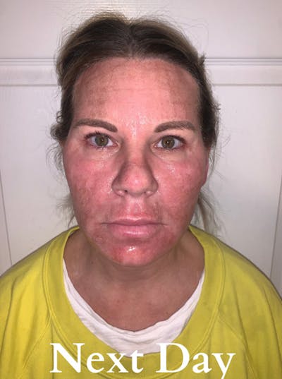 Cool Peel Before & After Gallery - Patient 87551924 - Image 2