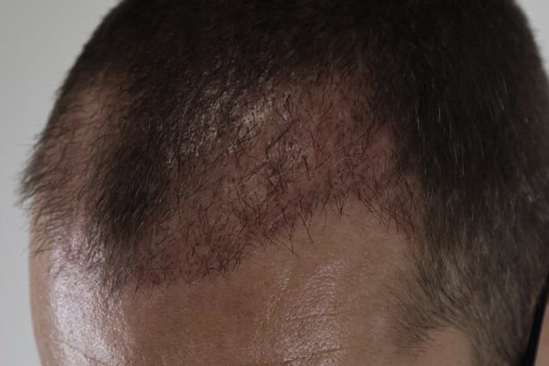 Hair Restoration Before & After Gallery - Patient 87551931 - Image 8