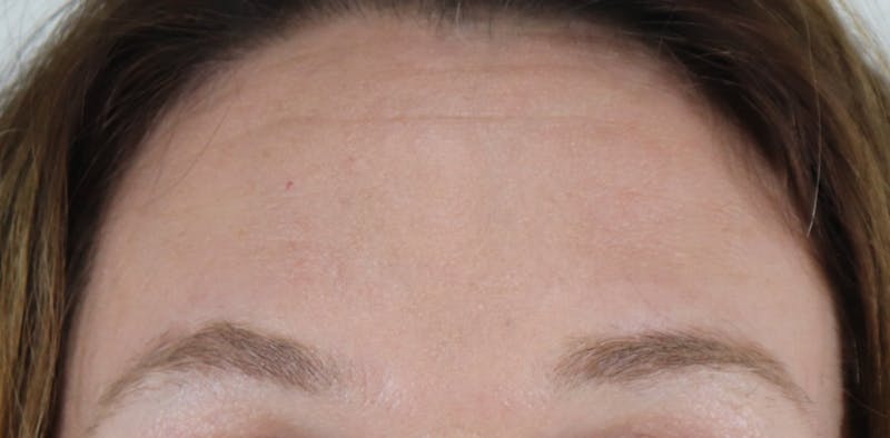 BOTOX Before & After Gallery - Patient 87551907 - Image 4