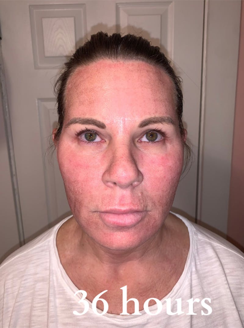 Cool Peel Before & After Gallery - Patient 87551924 - Image 3