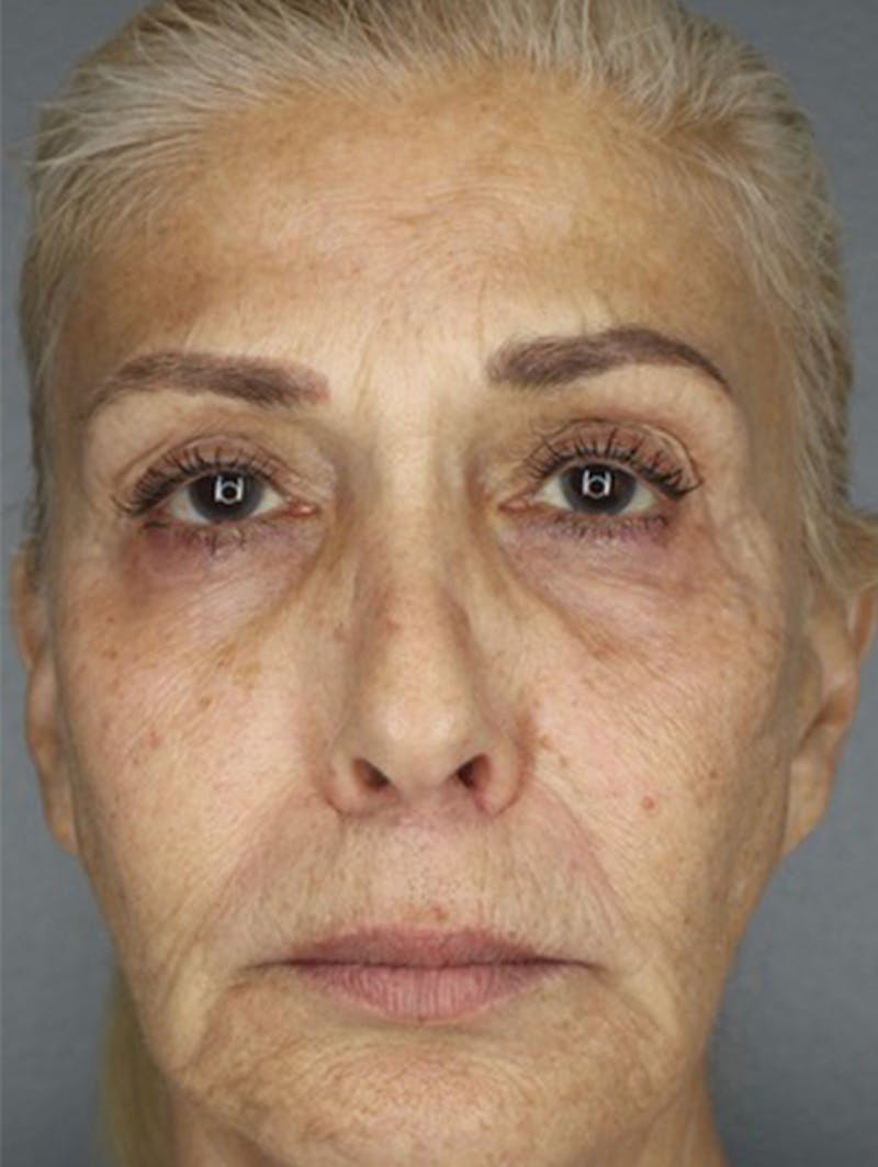 BOTOX Before & After Gallery - Patient 87551923 - Image 1