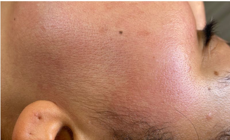 Dermaplaning Before & After Gallery - Patient 87551925 - Image 1