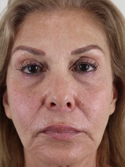 BOTOX Before & After Gallery - Patient 87551923 - Image 2