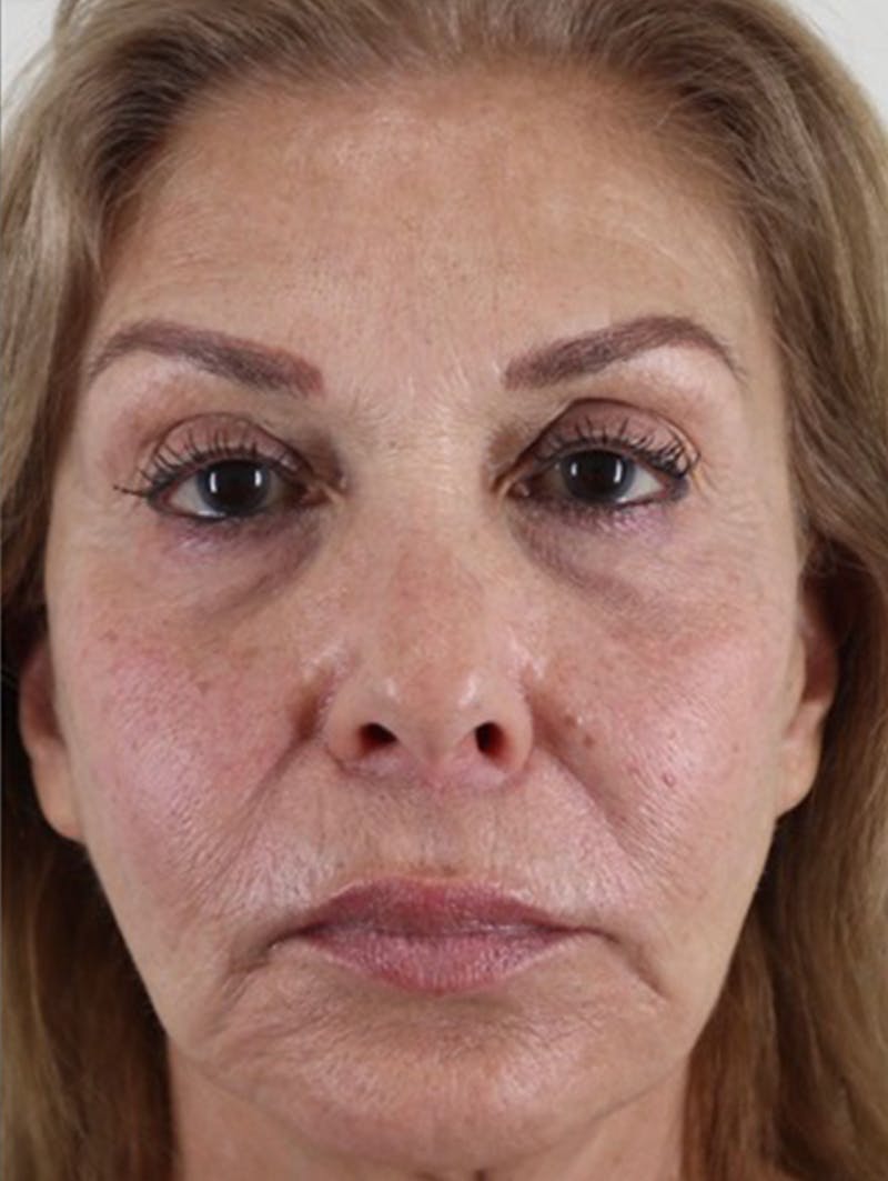 BOTOX Before & After Gallery - Patient 87551923 - Image 2