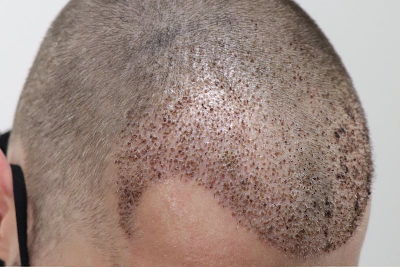 Hair Restoration Before & After Gallery - Patient 87551931 - Image 11
