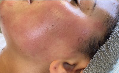 Dermaplaning Before & After Gallery - Patient 87551925 - Image 2