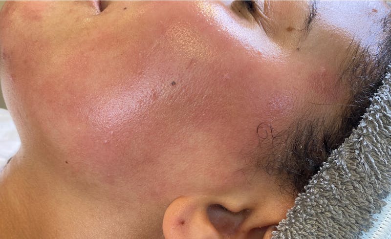 Dermaplaning Before & After Gallery - Patient 87551925 - Image 2