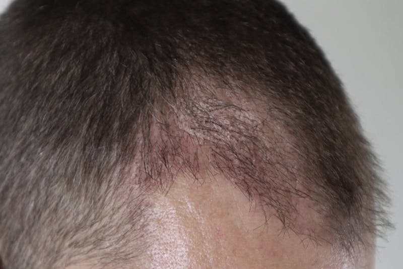 Hair Restoration Before & After Gallery - Patient 87551931 - Image 12