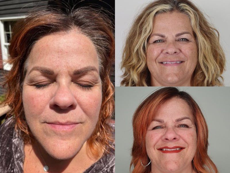 Cool Peel Before & After Gallery - Patient 87551932 - Image 1