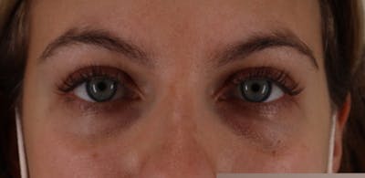 Tear Trough Filler Before & After Gallery - Patient 87551929 - Image 1