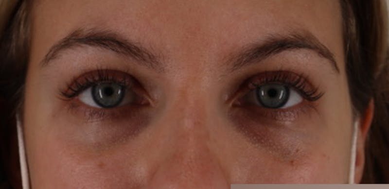 Tear Trough Filler Before & After Gallery - Patient 87551929 - Image 1