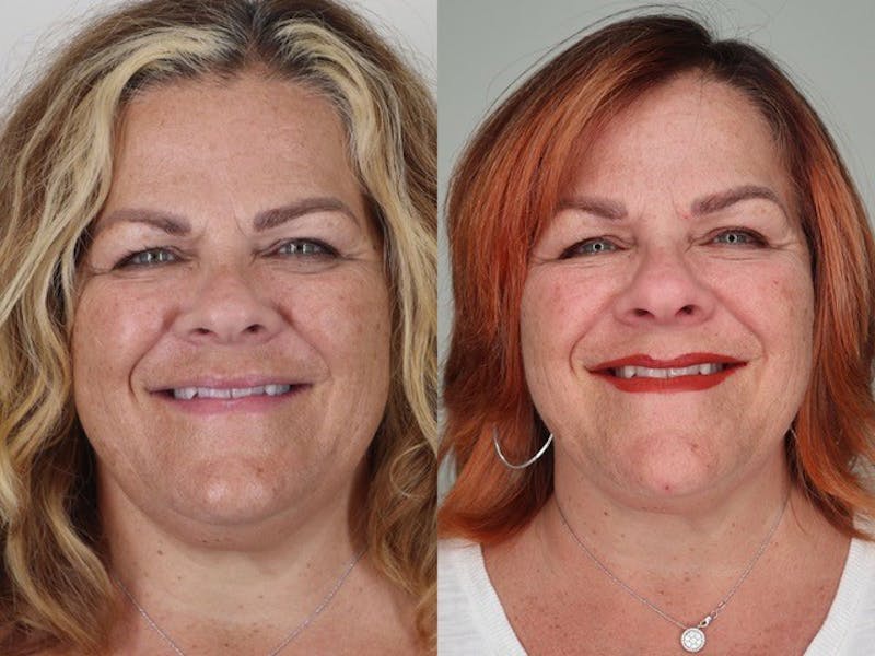 Cool Peel Before & After Gallery - Patient 87551932 - Image 2