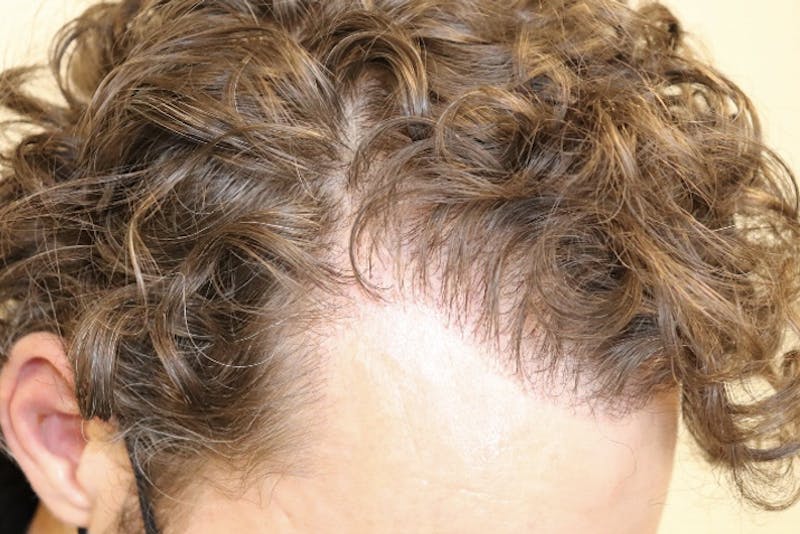 Hair Restoration Before & After Gallery - Patient 87551931 - Image 14