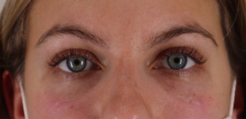 Tear Trough Filler Before & After Gallery - Patient 87551929 - Image 2