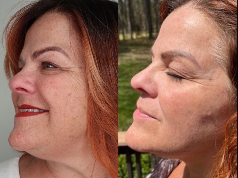 Cool Peel Before & After Gallery - Patient 87551932 - Image 3