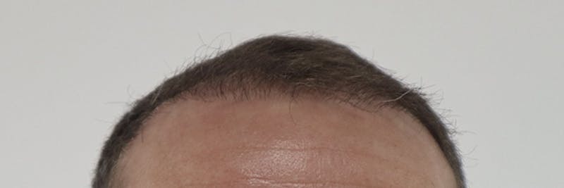Hair Restoration Before & After Gallery - Patient 87551931 - Image 15