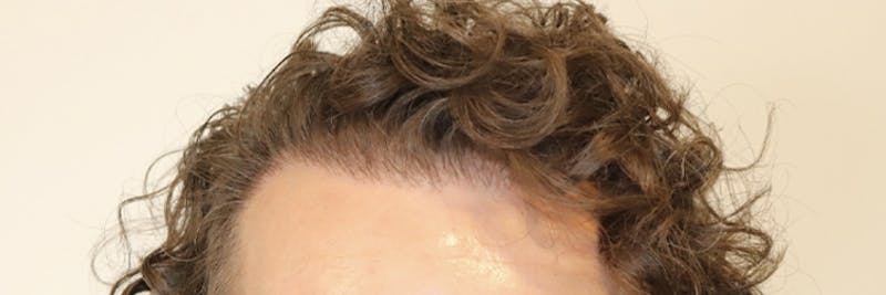 Hair Restoration Before & After Gallery - Patient 87551931 - Image 16