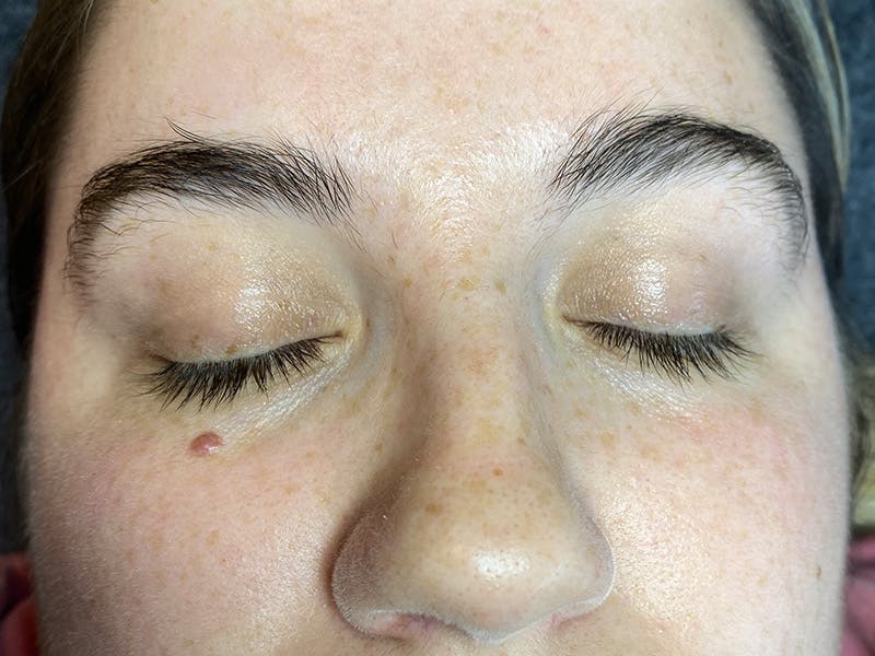 Eyelash Extension Before & After Gallery - Patient 87551950 - Image 1