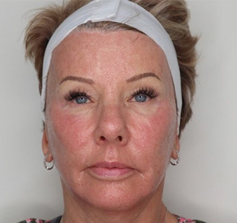 Cool Peel Before & After Gallery - Patient 87551956 - Image 2