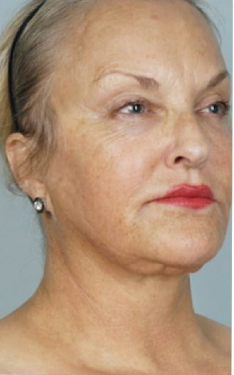 Cool Peel Before & After Gallery - Patient 87551960 - Image 1