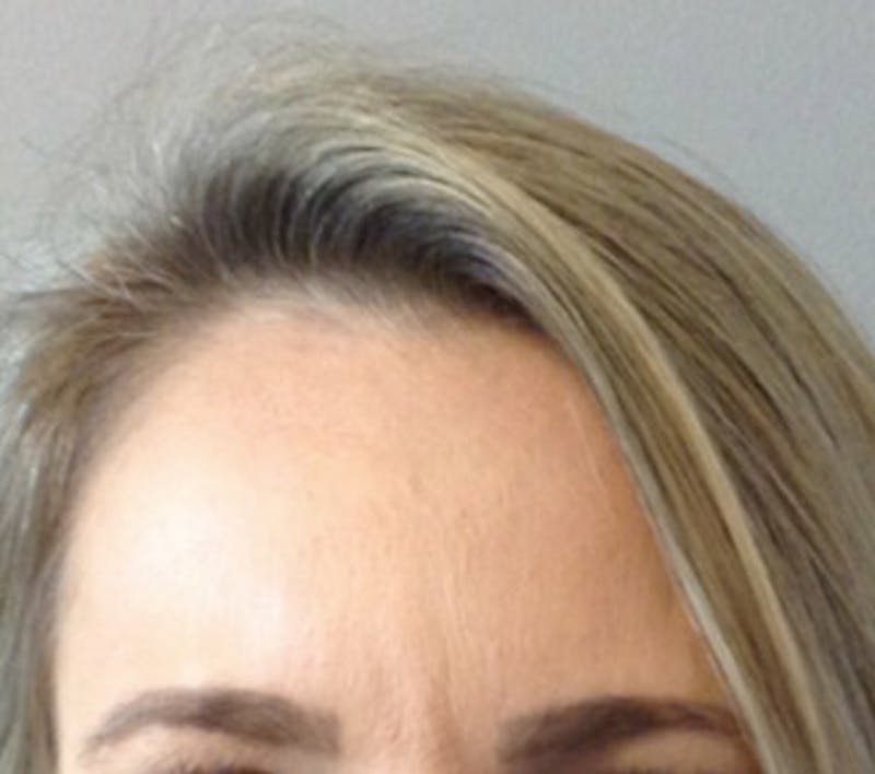 BOTOX Before & After Gallery - Patient 87551958 - Image 2