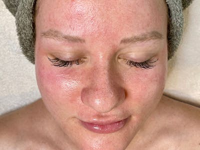 Facial Before & After Gallery - Patient 87551961 - Image 2