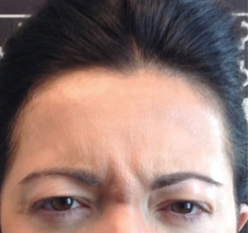 BOTOX Before & After Gallery - Patient 87551977 - Image 1