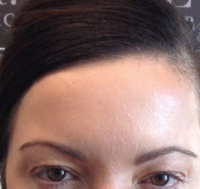 BOTOX Before & After Gallery - Patient 87551977 - Image 2