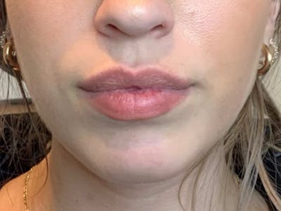 Jaw Filler Before & After Gallery - Patient 87552000 - Image 2