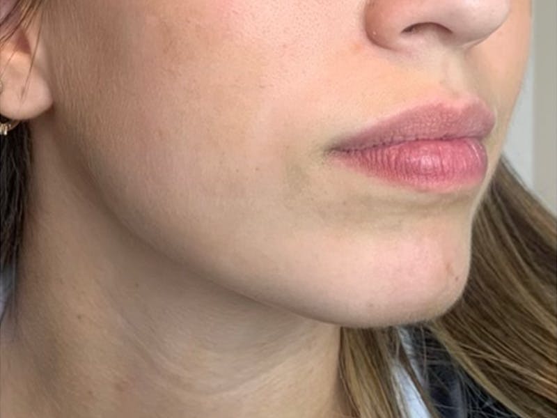 Jaw Filler Before & After Gallery - Patient 87552000 - Image 3